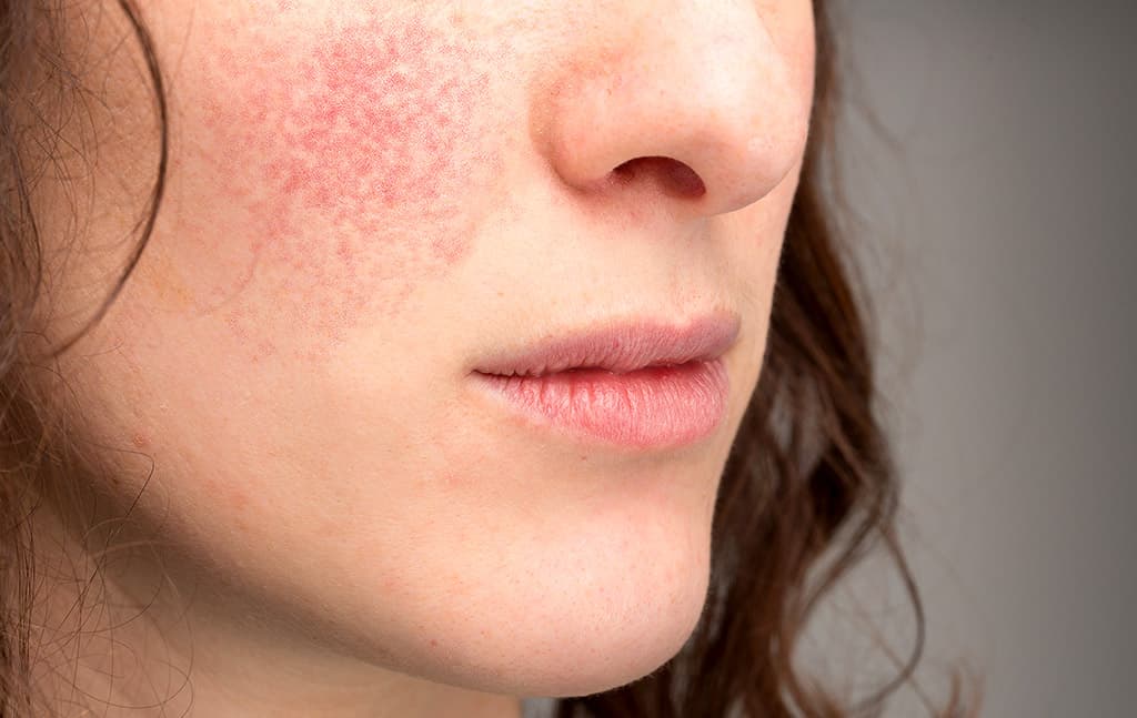 rosacea-hudkliniken-lidingo-puff