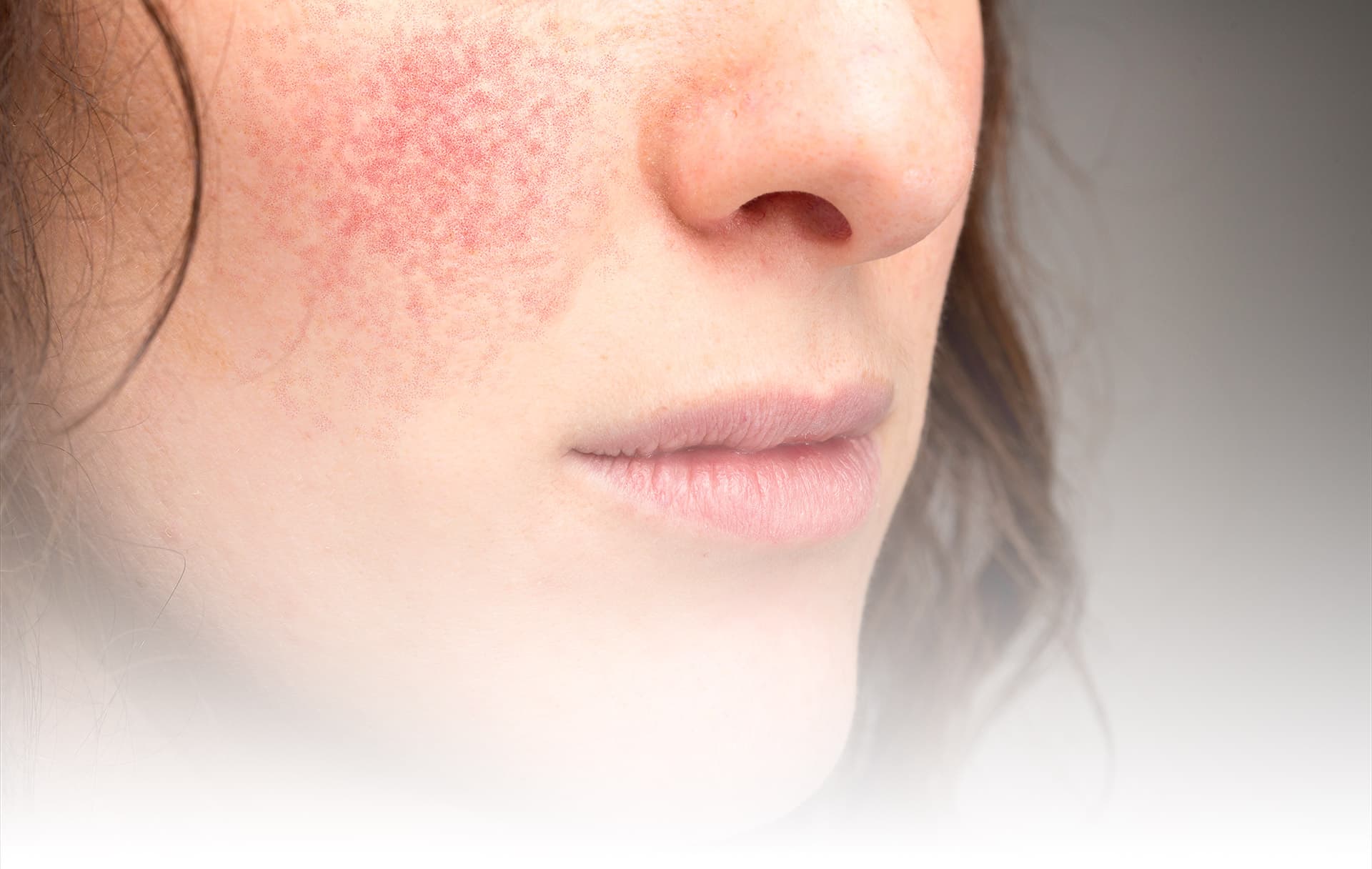 rosacea-hudkliniken-lidingo-mob